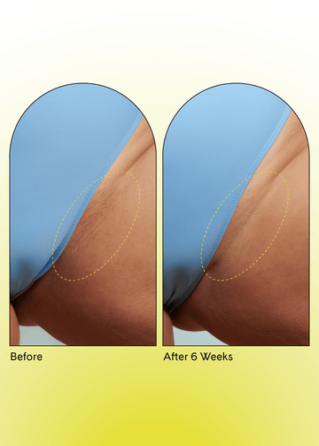 Ingrown Concentrate