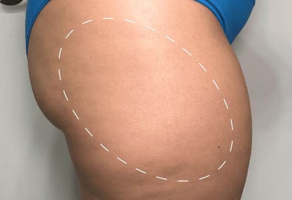 3 WEEKS USING FURMING OIL