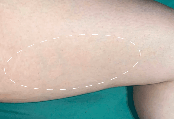 3 WEEKS USING FURMING OIL