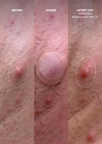 Ingrown Microdart Patch